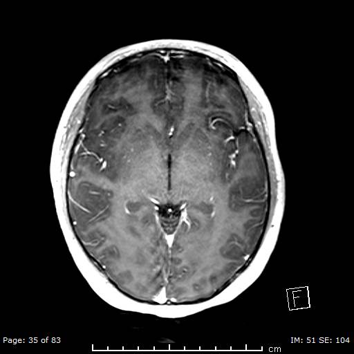 Balo concentric sclerosis (Radiopaedia 61637-69636 Axial T1 C+ 35).jpg