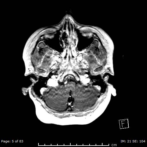 Balo concentric sclerosis (Radiopaedia 61637-69636 Axial T1 C+ 5).jpg