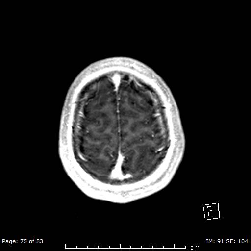 Balo concentric sclerosis (Radiopaedia 61637-69636 Axial T1 C+ 75).jpg