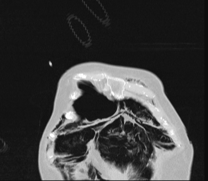 Barotrauma due to mechanical ventilation (Radiopaedia 28079-28336 Coronal lung window 11).jpg