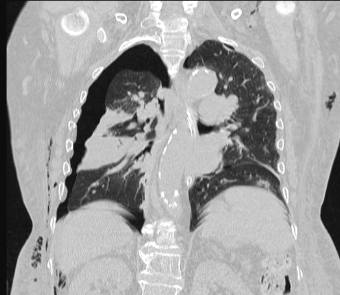 Barotrauma due to mechanical ventilation (Radiopaedia 28079-28336 Coronal lung window 60).jpg