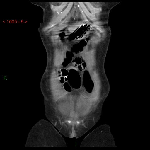 File:Bartholin gland cyst (Radiopaedia 54904-61181 Coronal C+ delayed 6).jpg