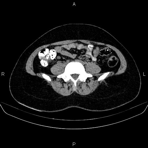 Bartholin gland cyst (Radiopaedia 62635-70930 Axial non-contrast 2).jpg