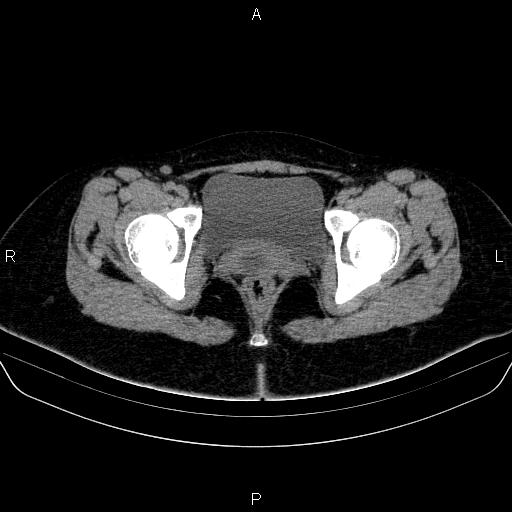 File:Bartholin gland cyst (Radiopaedia 62635-70930 Axial non-contrast 69).jpg