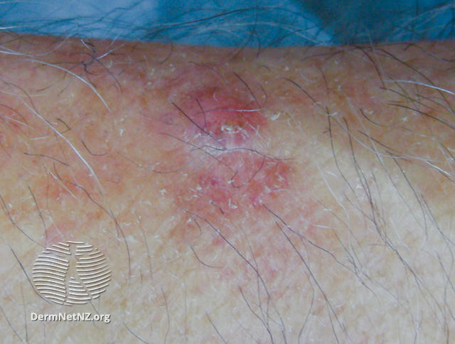 File:Basal cell carcinoma, arm (DermNet NZ bcc-arm-19-dn).jpg