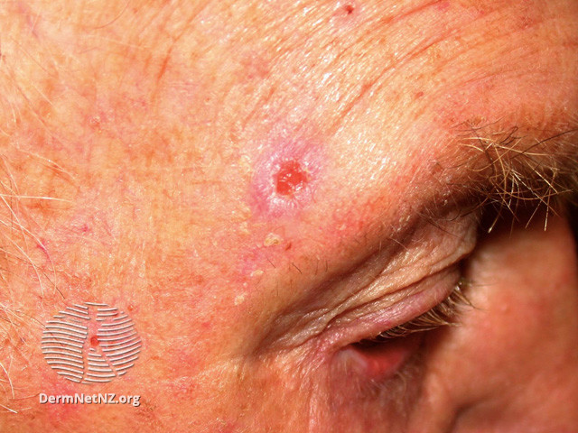 Basal cell carcinoma affecting the face (DermNet NZ lesions-bcc-face-1186).jpg
