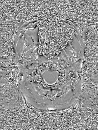 File:Base of skull chondrosarcoma (Radiopaedia 30410-31070 Axial SWI Phase 4).jpg