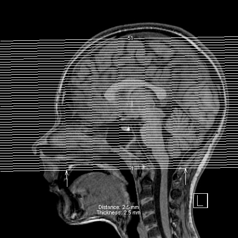 Base of skull rhabdomyosarcoma (Radiopaedia 32196-33142 Axial T1 52).jpg