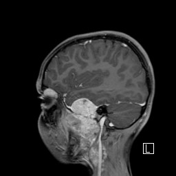 Base of skull rhabdomyosarcoma (Radiopaedia 32196-33142 J 19).jpg