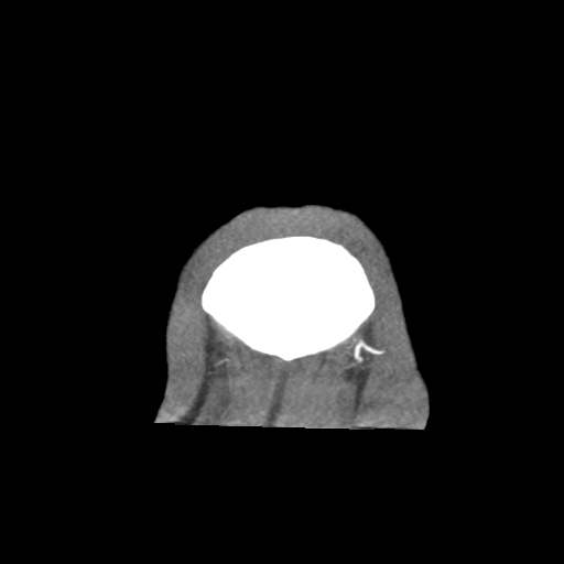Basilar and bilateral vertebral artery occlusion (Radiopaedia 45592-49723 B 101).png