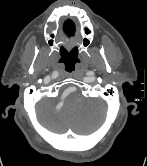 Basilar artery aneurysm (Radiopaedia 56261-62932 A 41).jpg