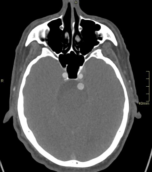 Basilar artery aneurysm (Radiopaedia 56261-62932 A 63).jpg