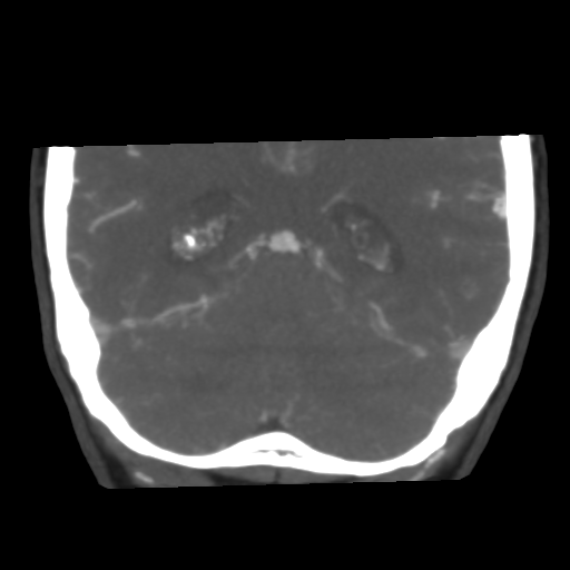 Basilar artery fenestration and aneurysms with subarachnoid hemorrhage (Radiopaedia 40066-42573 B 41).png