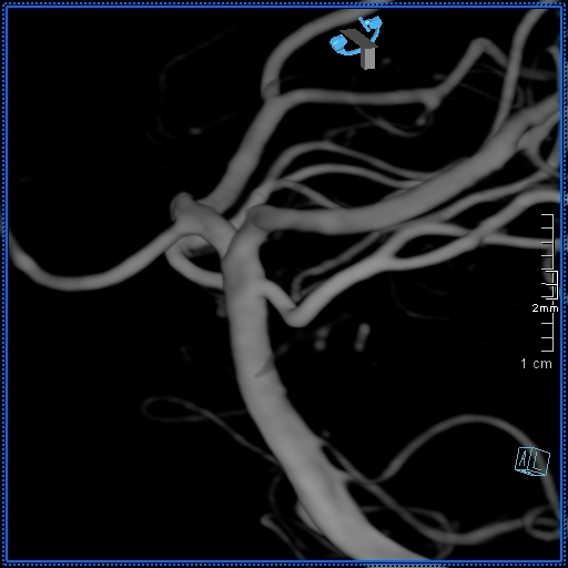 Basilar artery perforator aneurysm (Radiopaedia 82455-99524 3D Left VA 29).jpg