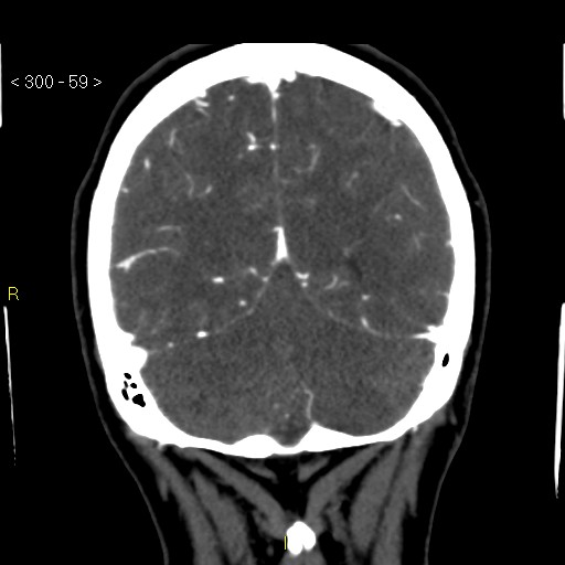 Basilar artery thrombosis (Radiopaedia 16260-15944 B 50).jpg