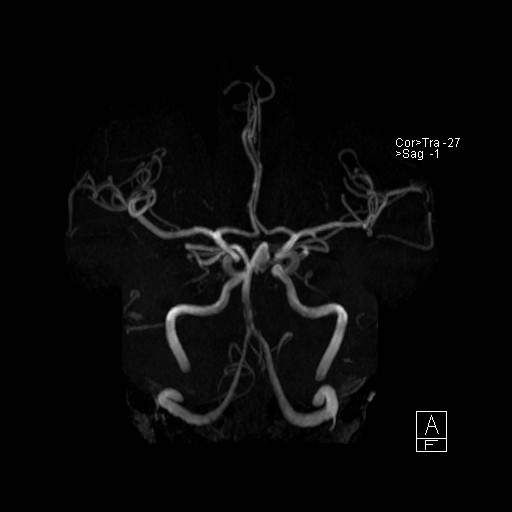 Basilar tip aneurysm (Radiopaedia 26504-26632 D 4).jpg