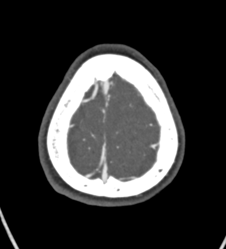 Basilar tip aneurysm with coiling (Radiopaedia 53912-60086 A 135).jpg