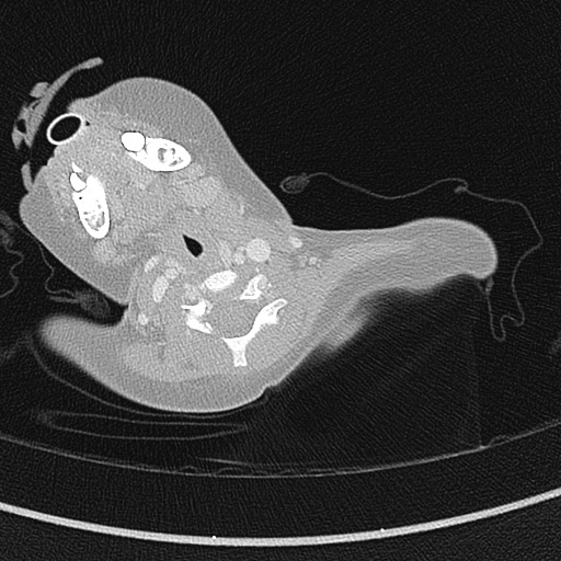 File:Beckwith-Wiedeman syndrome with bilateral Wilms tumors (Radiopaedia 60850-68629 Axial lung window 1).jpg