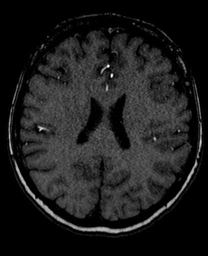 Berry aneurysm of the terminal internal carotid artery (Radiopaedia 88286-104918 Axial TOF 150).jpg