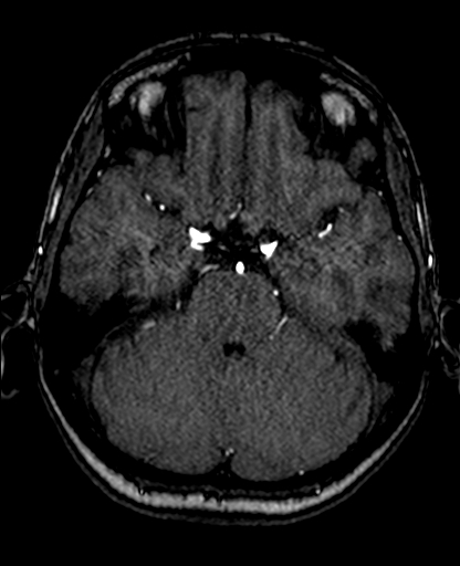 File:Berry aneurysm of the terminal internal carotid artery (Radiopaedia 88286-104918 Axial TOF 91).jpg