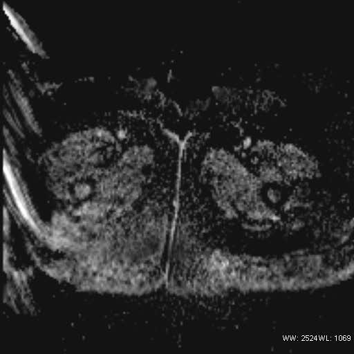 File:Bicornuate uterus- on MRI (Radiopaedia 49206-54297 Axial ADC 27).jpg
