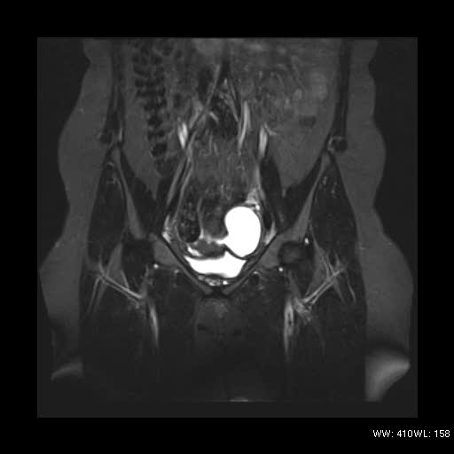 File:Bicornuate uterus- on MRI (Radiopaedia 49206-54297 Coronal STIR 6).jpg