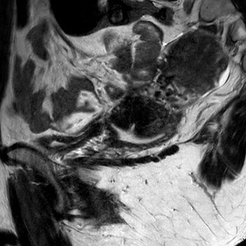 File:Bicornuate uterus (Radiopaedia 61974-70046 Sagittal T2 6).jpg