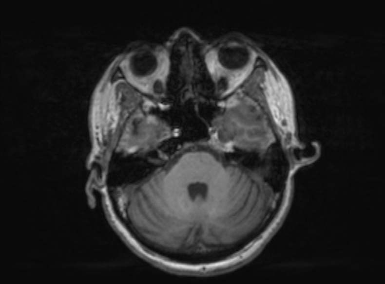 File:Bilateral PCA territory infarction - different ages (Radiopaedia 46200-51784 Axial T1 298).jpg