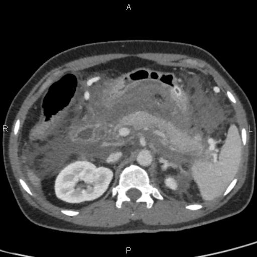 Bilateral adrenal gland hyperenhancement in pancreatitis (Radiopaedia 86642-102753 E 33).jpg