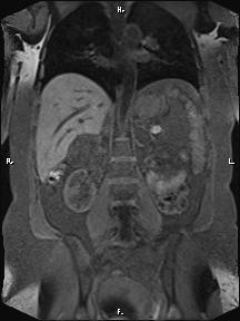 Bilateral adrenal myelolipoma (Radiopaedia 63058-71537 Coronal T1 fat sat 45).jpg