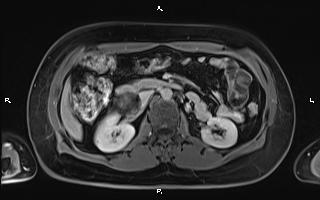 File:Bilateral adrenal myelolipoma (Radiopaedia 63058-71537 H 49).jpg