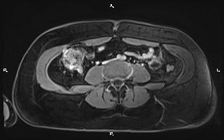 Bilateral adrenal myelolipoma (Radiopaedia 63058-71537 H 72).jpg