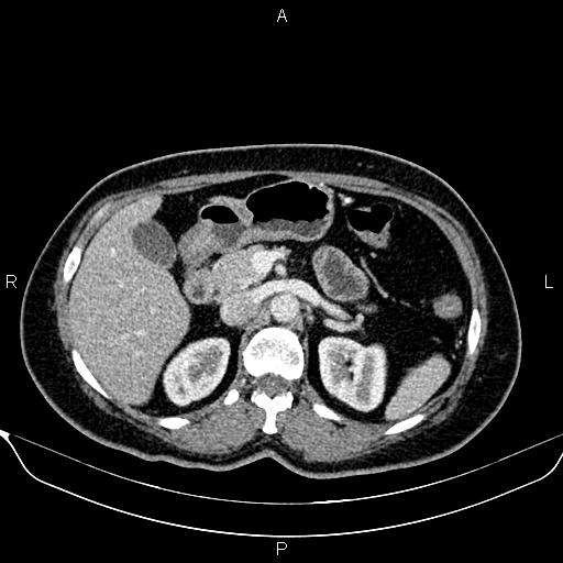 Bilateral benign adrenal adenomas (Radiopaedia 86912-103124 B 38).jpg