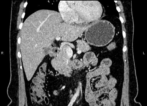 Bilateral benign adrenal adenomas (Radiopaedia 86912-103124 D 23).jpg