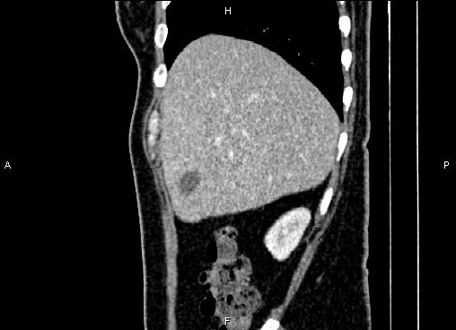 Bilateral benign adrenal adenomas (Radiopaedia 86912-103124 E 18).jpg
