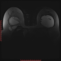 File:Bilateral breast implant rupture (Radiopaedia 24761-25027 PASTA Si 10).jpg