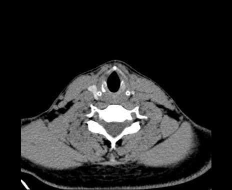 Bilateral carotid body tumors (Radiopaedia 61841-69870 Axial non-contrast 80).jpg