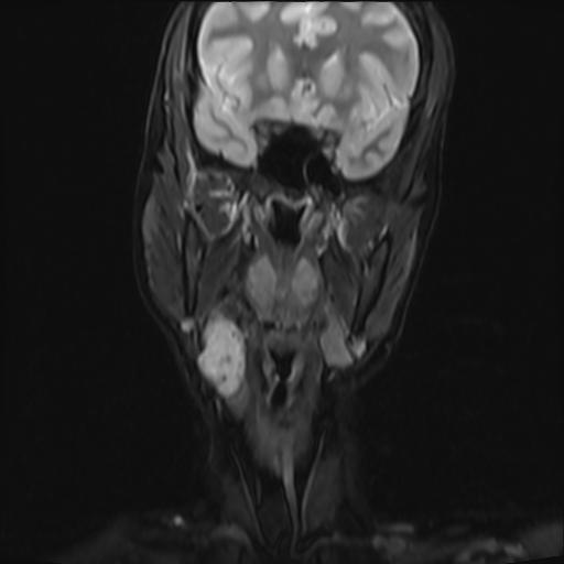 File:Bilateral carotid body tumors and right jugular paraganglioma (Radiopaedia 20024-20060 Coronal 34).jpg