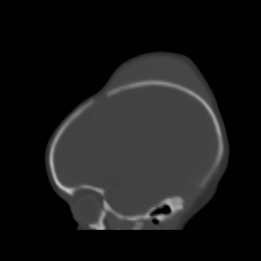 File:Bilateral cephalohematomas and subdural hematomas (Radiopaedia 26778-26929 Sagittal bone window 9).jpg