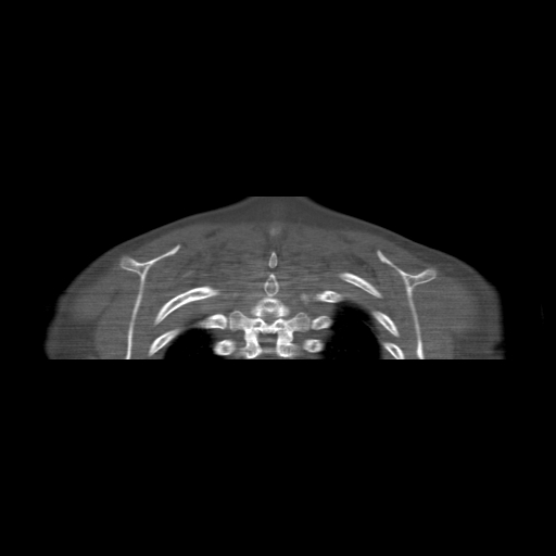 Bilateral chronic posterior shoulder dislocation (Radiopaedia 39213-41452 Coronal bone window 55).jpg