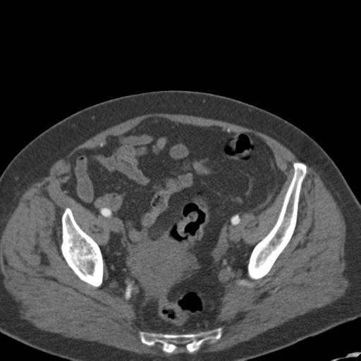File:Bilateral delayed nephrogram from renal artery stenosis (Radiopaedia 47681-52362 A 54).png