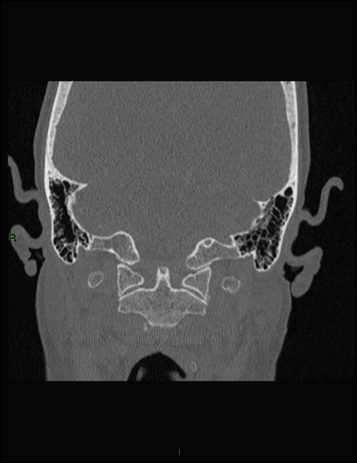Bilateral frontal mucoceles (Radiopaedia 82352-96454 Coronal 349).jpg