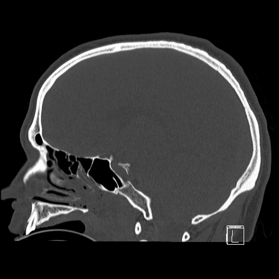 Bilateral occipital condyle fracture (type 2) (Radiopaedia 87675-104089 Sagittal bone window 47).jpg