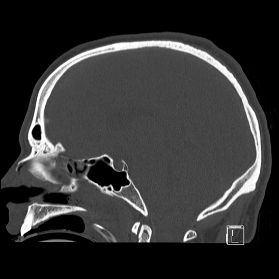 Bilateral occipital condyle fracture (type 2) (Radiopaedia 87675-104089 Sagittal bone window 53).jpg