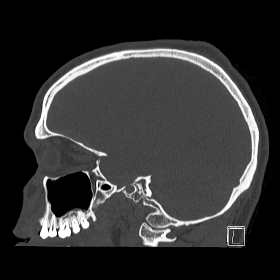 Bilateral occipital condyle fracture (type 2) (Radiopaedia 87675-104089 Sagittal bone window 75).jpg