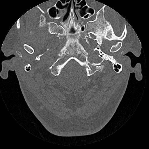 File:Bilateral ossifications of the external auditory canal (Radiopaedia 15233-15076 Axial bone window 23).jpg