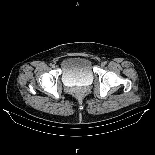 File:Bilateral ovarian dermoid cysts (Radiopaedia 85785-101603 Axial C+ delayed 84).jpg