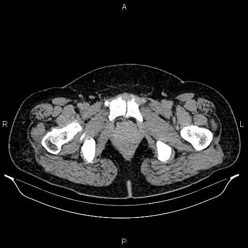 Bilateral ovarian dermoid cysts (Radiopaedia 85785-101603 Axial C+ delayed 90).jpg
