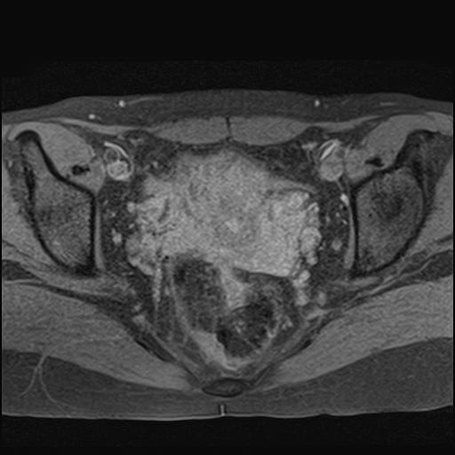 File:Bilateral ovarian endometriomas (Radiopaedia 87085-103347 Axial T1 fat sat 13).jpg