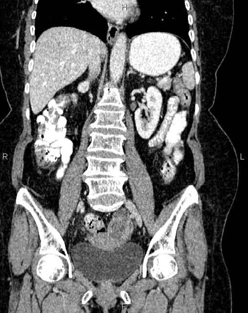 Bilateral ovarian serous cystadenocarcinoma (Radiopaedia 86062-101989 D 27).jpg